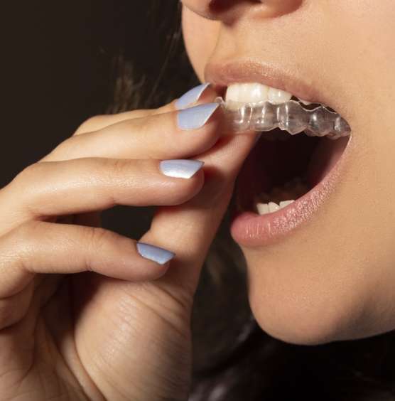Invisalign Alignment - Friedman Dental Group