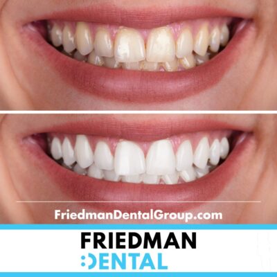 Before and After Teeth Whitening in Friedman Dental Miami